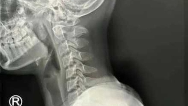 Bé gái 9 tuổi cột sống cổ "gập về phía trước", già như bà cụ 50 vì thứ mà trẻ nhỏ lẫn người lớn đều mê