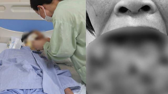 Ăn thực dưỡng tự điều trị bệnh, người phụ nữ mang khối u môi dưới lở loét với kích thước khủng