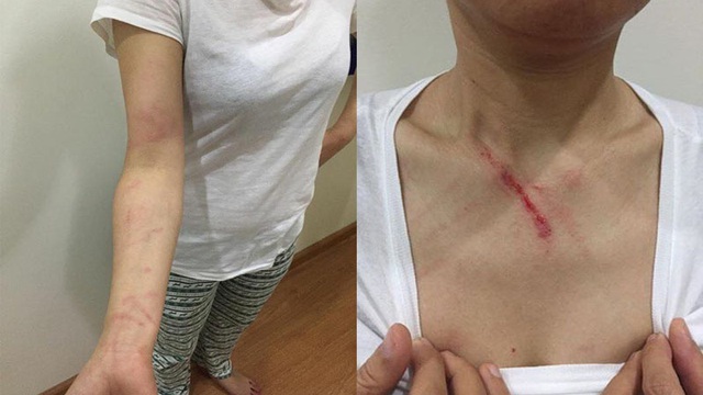 Hà Nội: Thấy người khác nhổ nước bọt ở thang máy, người phụ nữ nhắc thì bị đánh tới tấp