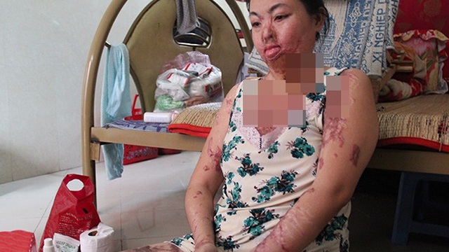 “Người mẹ ma” ở TP HCM: "Ước gì tôi biết vì sao mình bị tạt axit tàn độc đến thế"