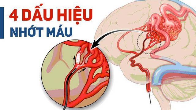 BS cảnh báo: 4 dấu hiệu cho thấy mạch máu đang dần bị tắc, xử lý ngay để tránh nguy hiểm