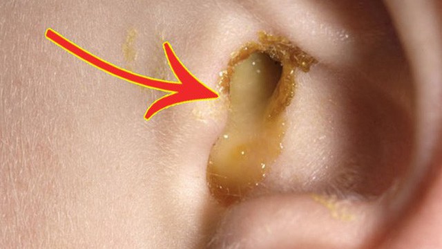 Bé gái bị thủng màng nhĩ do sự chủ quan của người mẹ