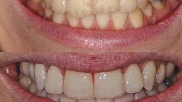 Răng hỏng vì chọn sai kem đánh răng: Chuyên gia khuyến cáo 3 việc hại răng không nên làm