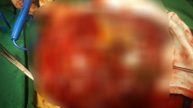 Cảm thấy ăn khó tiêu, đến viện khám phát hiện "vật lạ" khủng