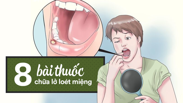 [Bài thuốc quý] Lở loét miệng gây đau đớn: Nên thử 8 cách chữa bằng thực phẩm đơn giản