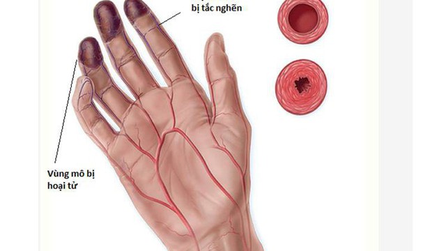3 dấu hiệu bất thường ở tay chân: 80% khả năng bạn bị tắc mạch máu, nên xử lý ngay