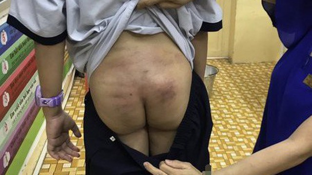Vết bầm tím trên cơ thể bé trai ở Sài Gòn hé lộ nghi vấn bạo hành