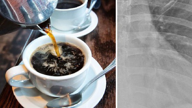 Người phụ nữ 30 tuổi này đã uống 10 tách cà phê mỗi ngày và bác sĩ đã sửng sốt khi nhìn kết quả X-quang của cô