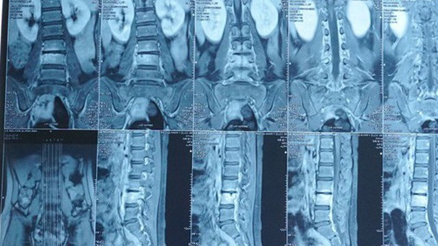 Cô bé bất ngờ lộ bệnh hiếm sau khi va vào cạnh bàn