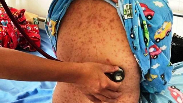 Cảnh báo nhiều trẻ mắc sởi biến chứng nặng vì không tiêm vắc xin