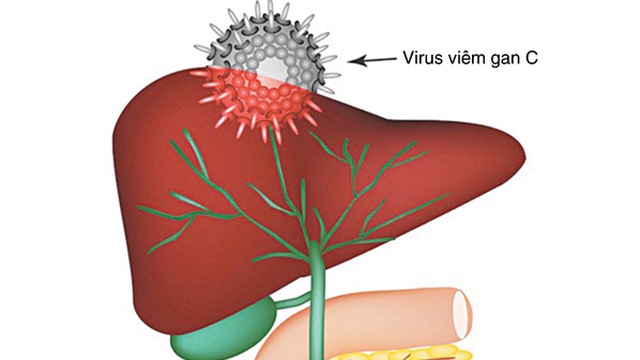 Viêm gan siêu vi C nguy hiểm đến mức nào?