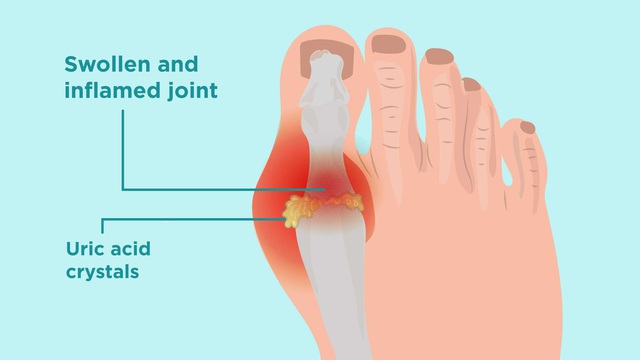 Công thức '3 nhiều 3 ít' để hạ Axit Uric trong máu: Người trẻ hay già đều nên quan tâm