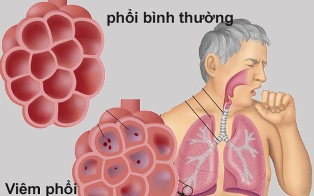 Loại nước tốt cho người viêm phổi