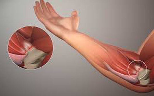 Đau khớp khuỷu tay: Nguyên nhân và cách xử trí