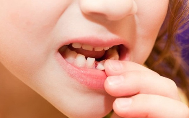 Tự nhổ răng sữa ở nhà, răng vĩnh viễn dễ lệch?