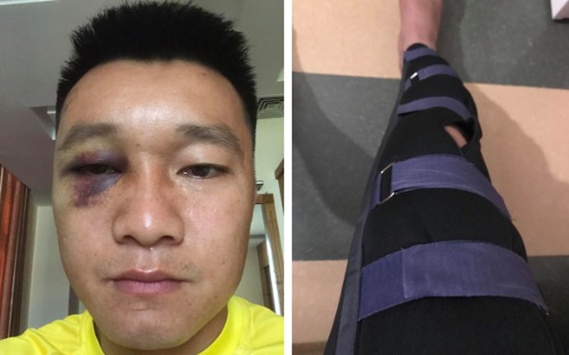 Cựu tuyển thủ Việt Nam mắt thâm sì, chấn thương nặng sau va chạm mạnh với đồng đội