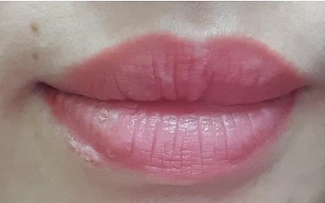 Cảnh báo nhiễm herpes khi xăm môi