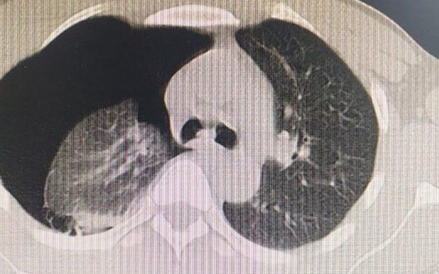 Tràn khí màng phổi - những biến chứng không thể chủ quan