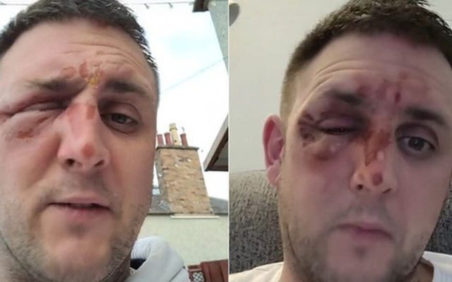 Nấu trứng bằng lò vi sóng theo công thức trên TikTok, người đàn ông bỏng nặng vùng mặt