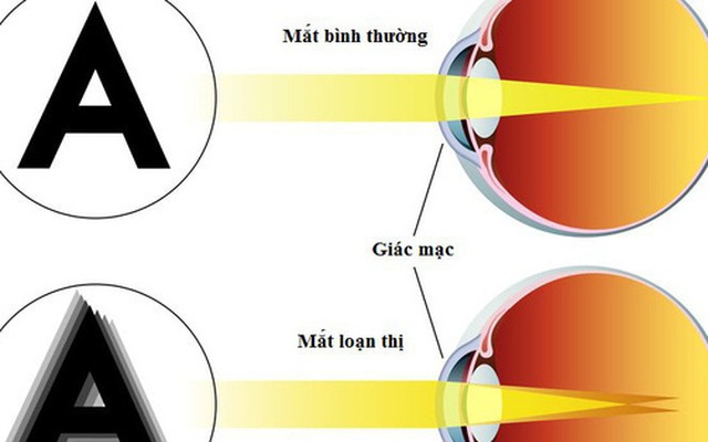 Loạn thị có chữa được không? Điều trị loạn thị như nào?