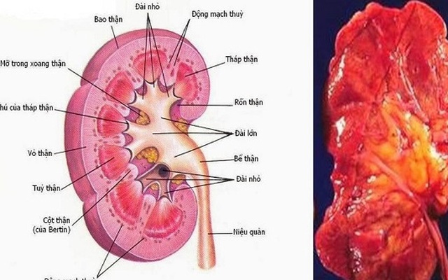 Bài thuốc hỗ trợ trị viêm cầu thận cấp