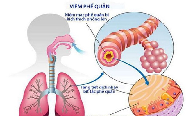 Cảnh giác biến chứng của viêm phế quản cấp