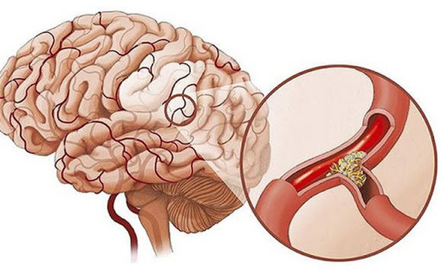 Nguyên nhân gây thiếu máu não