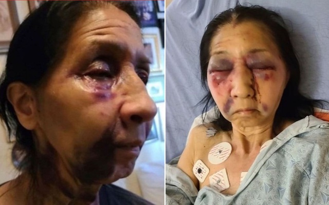 Cụ bà Mexico bị đánh thâm tím mặt trên xe buýt Mỹ vì ‘trông giống người châu Á’