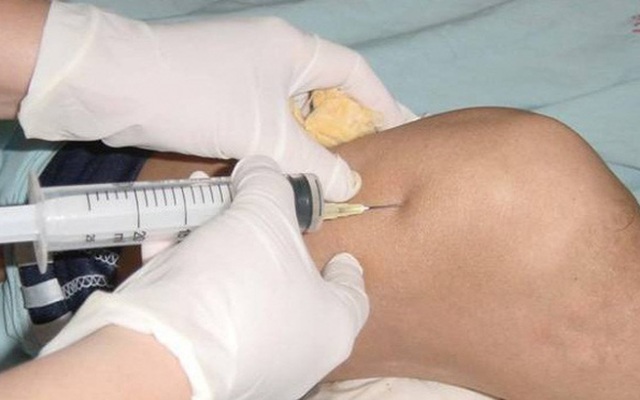 Sưng đau khớp gối đến phòng khám tư tiêm thuốc, cụ ông bị suy hô hấp