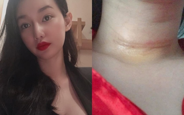 MC Quỳnh Chi phải phẫu thuật vì phát hiện tế bào ung thư tuyến giáp, vết sẹo lớn để lại trên cổ gây xót xa