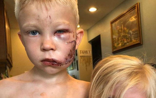 Bé trai 6 tuổi bị chó cắn rách mặt khi cứu em gái giờ ra sao?