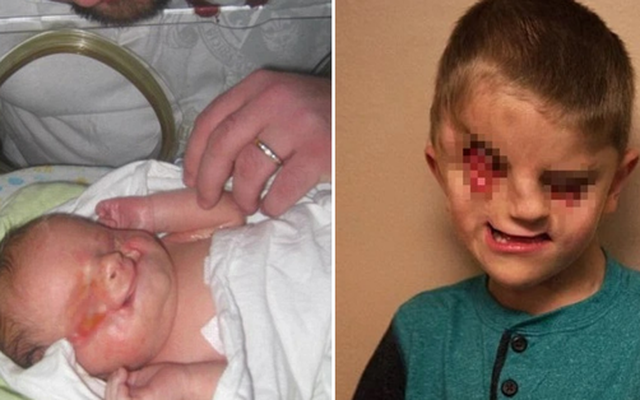 Bé trai sinh ra hoàn toàn không có mắt bị kỳ thị là "dị nhân", cuộc sống khi lớn lên sau 7 ca phẫu thuật khiến người đời khâm phục