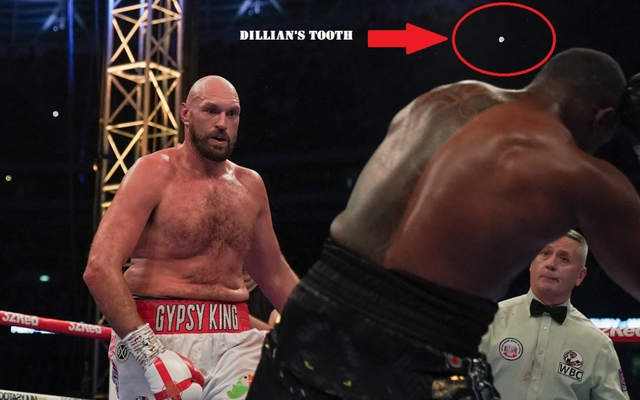 Cú KO của Tyson Fury khiến Dillian Whyte bay mất răng?