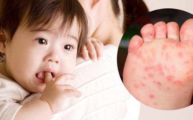 Những điều cha mẹ cần lưu ý khi chăm sóc trẻ mắc bệnh tay chân miệng