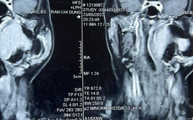 Sưng phồng vùng mang tai, không ngờ lại mắc khối u hiếm gặp, phức tạp vùng đầu cổ