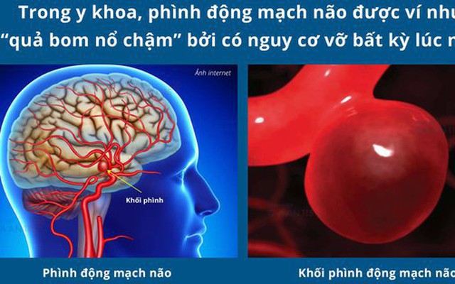 Người đàn ông bị phình động mạch não giữa kích thước "khổng lồ"