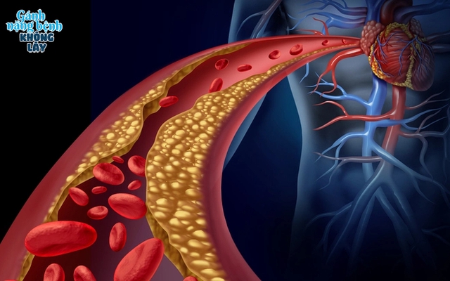 Mỡ máu cao - "sát thủ thầm lặng" gây đột quỵ: 4 nhóm người dễ mắc, số 1 đặc biệt nguy hiểm