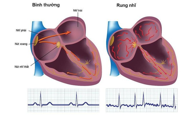 AI Việt phát hiện cơn rung nhĩ chính xác khoảng 84%