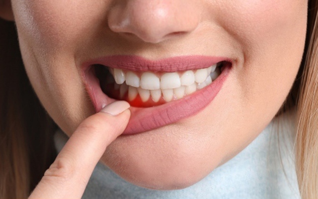 7 hậu quả nghiêm trọng nếu lười đánh răng