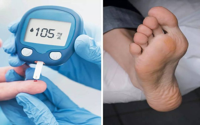 Chân là "máy đo đường huyết" nếu chân có 3 dấu hiệu lạ, cẩn thận đường huyết tăng vọt, tiểu đường tìm đến