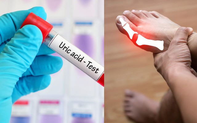 10 cách 'đào thải' acid uric một cách tự nhiên, ngừa gout hiệu quả: Nhiều người chưa biết để làm