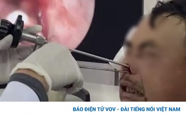 Nam bệnh nhân ở Lào Cai phải cấp cứu với hơn 100 con giòi trong hốc mũi