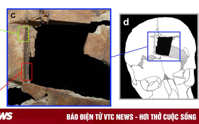 Bí ẩn ca phẫu thuật khoan hộp sọ cách đây 3.500 năm