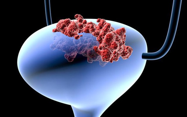 Đột phá: Xét nghiệm nước tiểu dự báo ung thư 12 năm trước khi phát bệnh