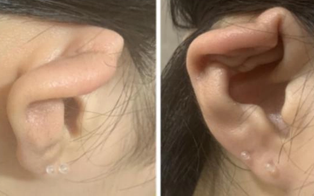 Nữ sinh 15 tuổi xỏ lỗ tai gây viêm màng sụn, biến dạng vành tai, chuyên gia cảnh báo