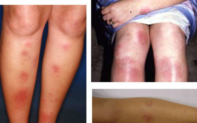 Căn bệnh hay gặp ở các chị em 20-30 tuổi khiến da sẩn cục, nóng đỏ