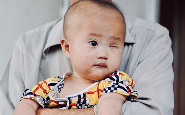 Lời khẩn cầu của ông nội xin cứu bé gái 14 tháng tuổi phải bỏ một bên mắt vì ung thư