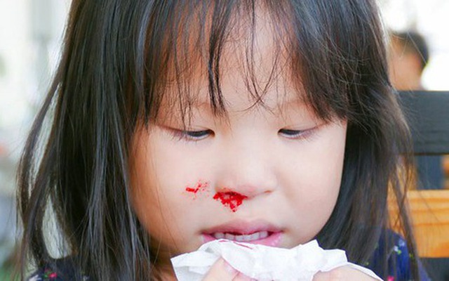 Bé trai 3 tuổi nguy kịch do bà nội xử lý chảy máu cam sai cách