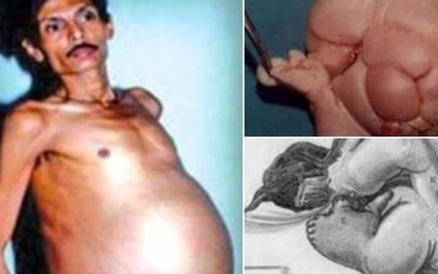 Người đàn ông mang trong mình "thai chết lưu" suốt 36 năm, bào thai nặng 4kg, có cả tóc và tay chân