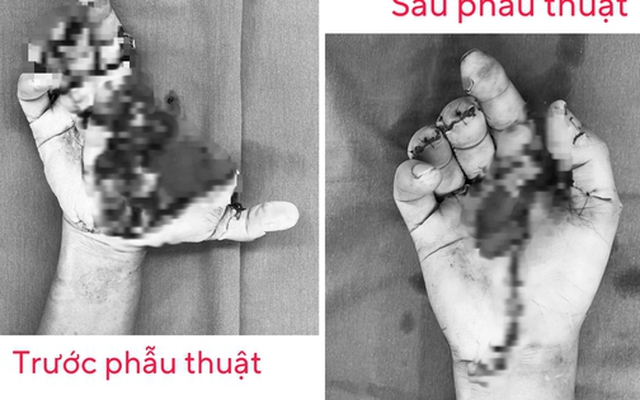 Một bệnh viện tiếp nhận 15 ca tai nạn do pháo nổ trong ngày